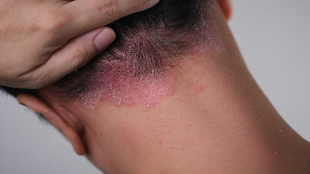 Here Is What You Should Know About Atopic Dermatitis Smart Consumer